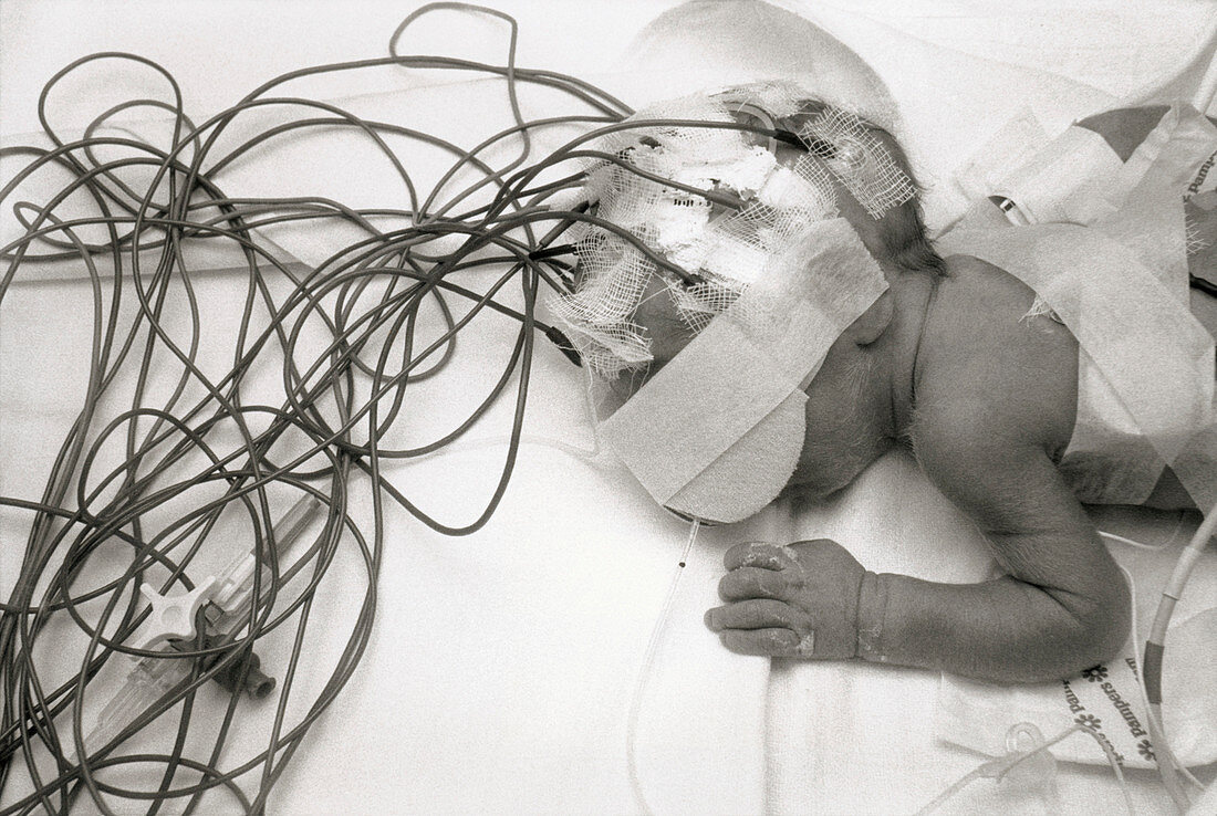 EEG electrodes taped to head of premature baby