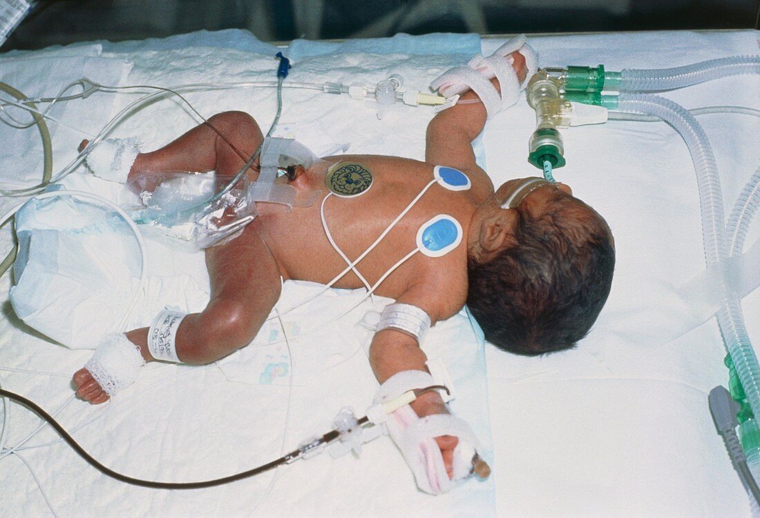 Premature baby in an intensive care unit