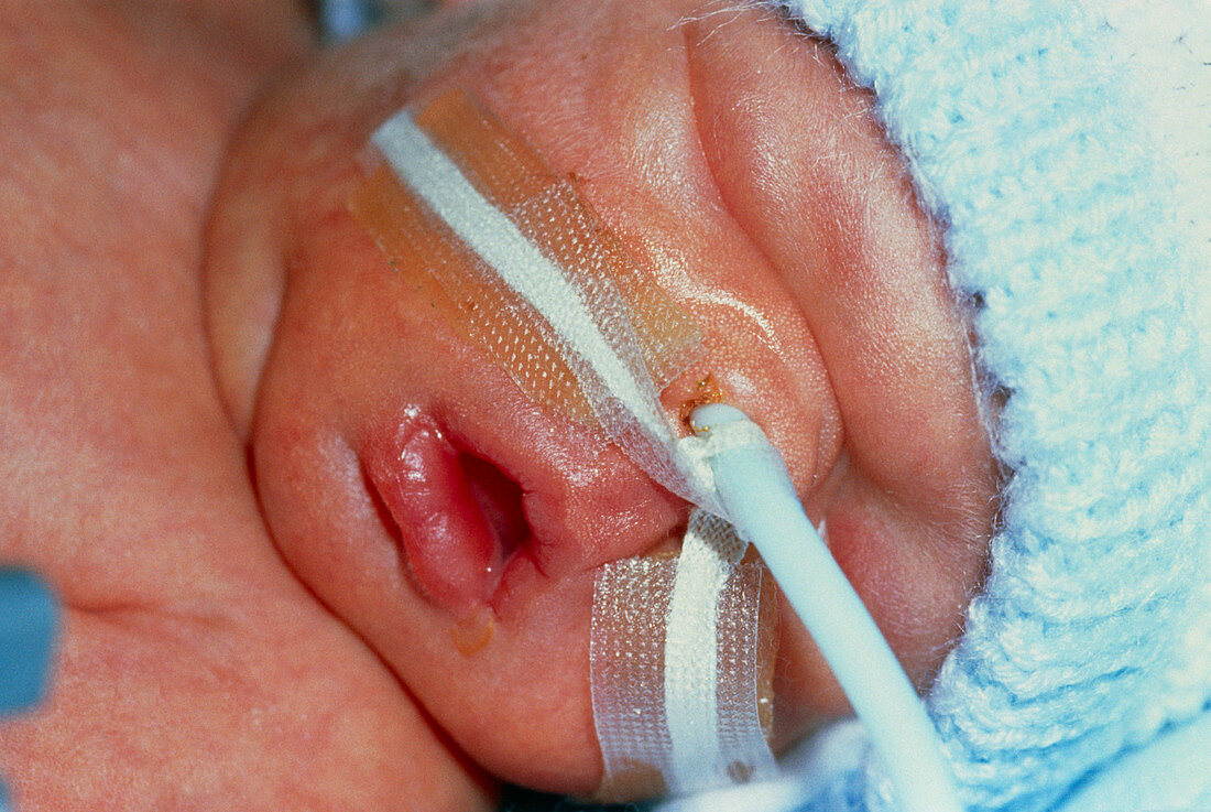 Face of premature baby in an intensive care unit