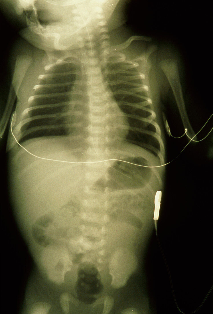X-ray of premature baby with life support devices