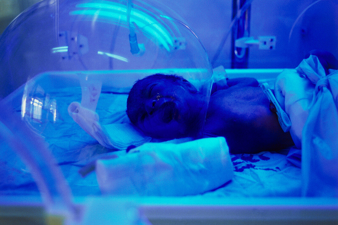 Newborn baby receiving phototherapy in incubator