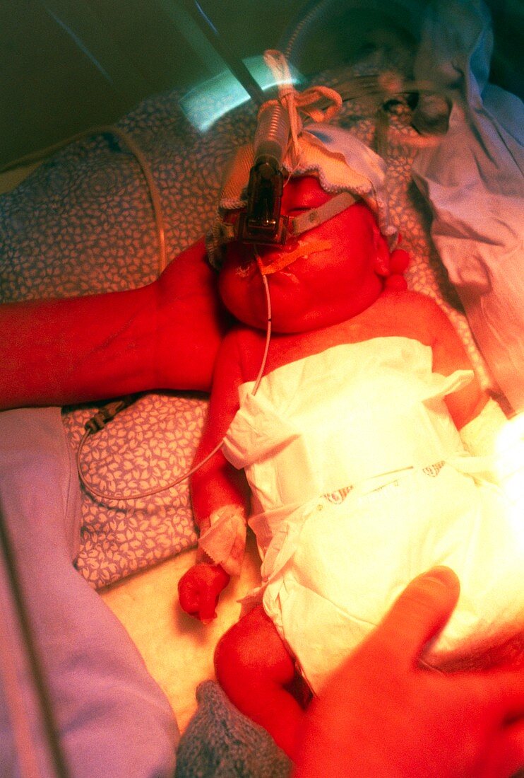 Premature baby in an incubator on a respirator