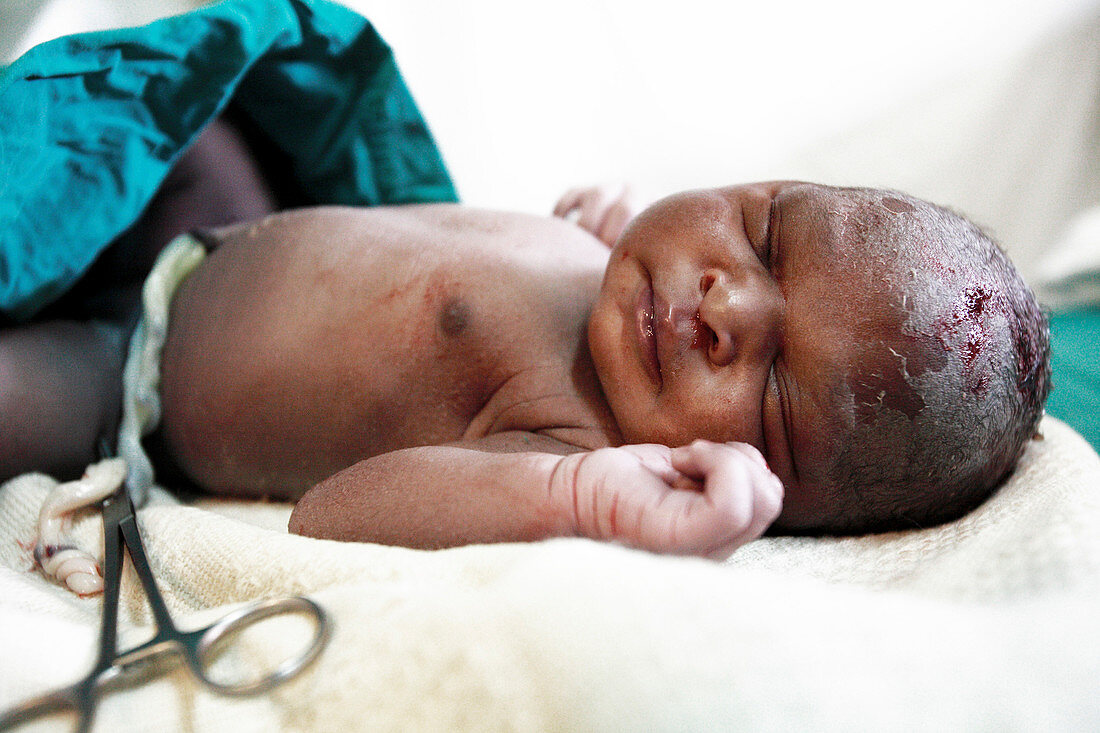 Newborn baby after Caesarean