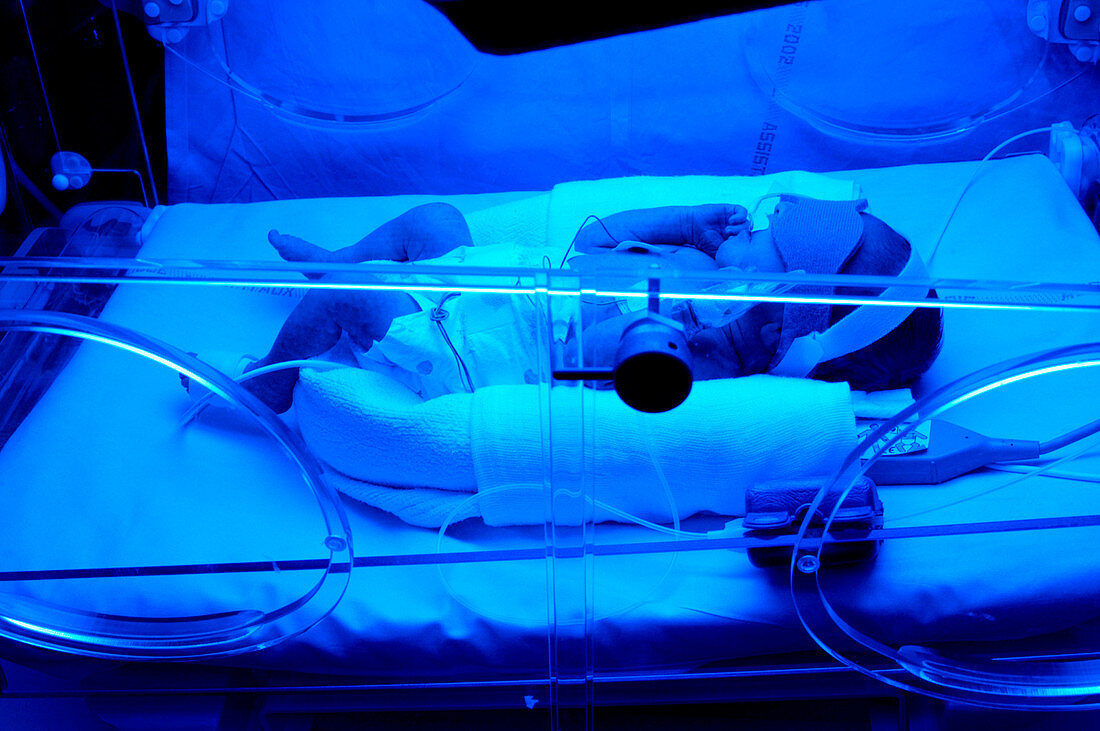Premature baby receiving phototherapy