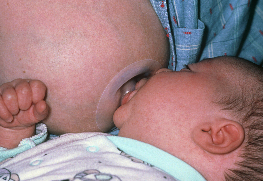 Baby feeding from breast with nipple shield