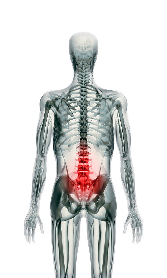 Back pain,X-ray artwork