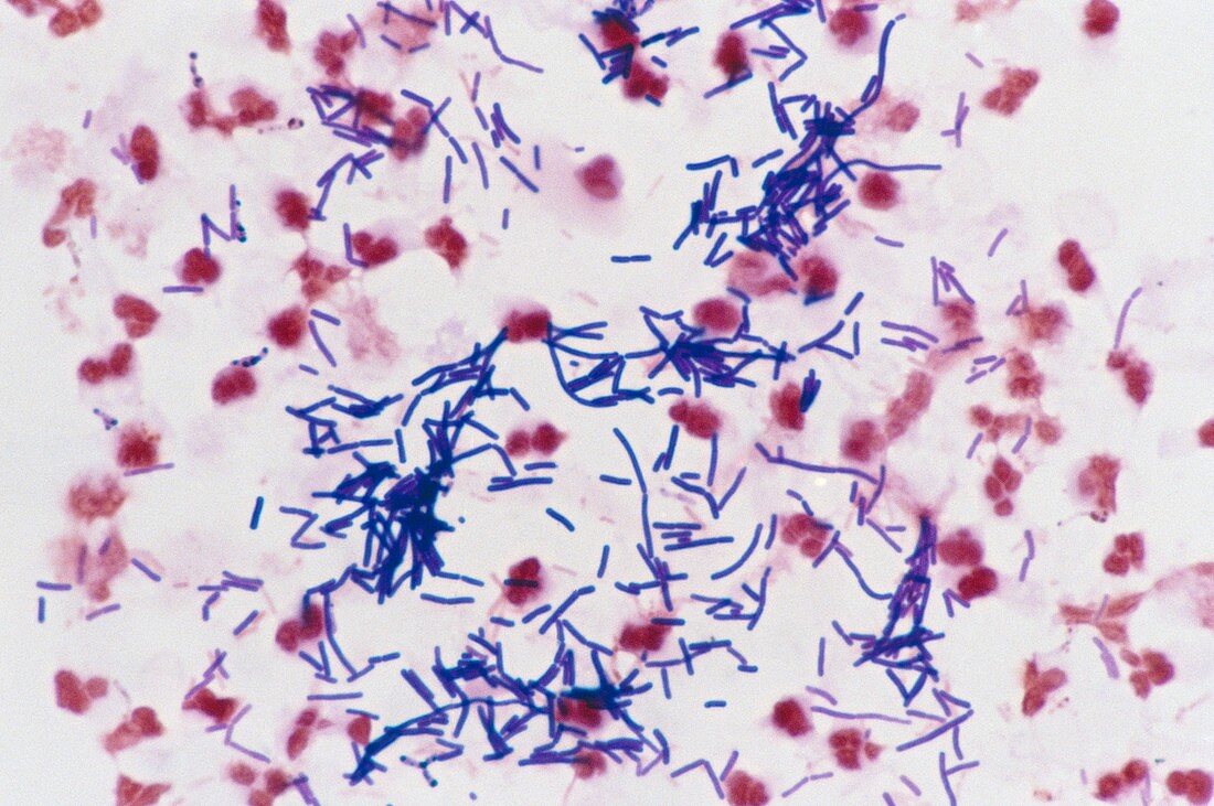 LM of vaginal smear of diabetic woman: bacteria