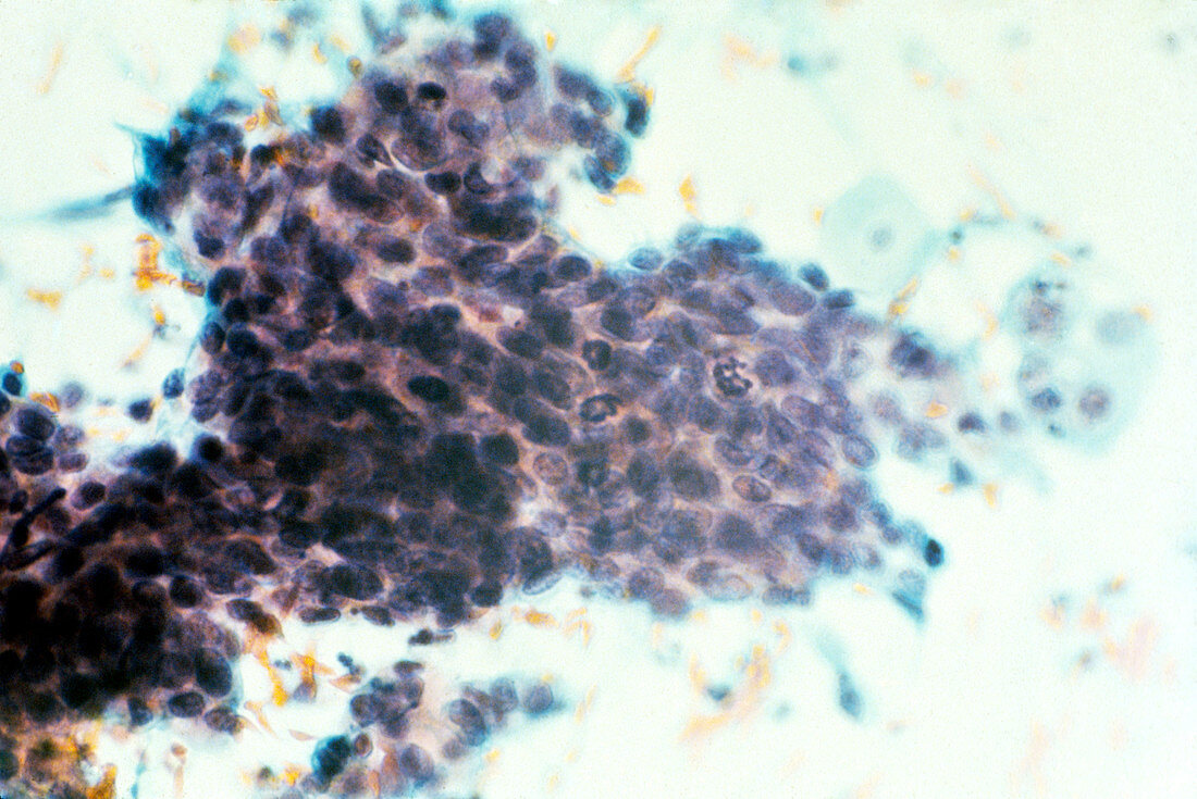 Lm of cervical smearshowing pre-invasive cancer