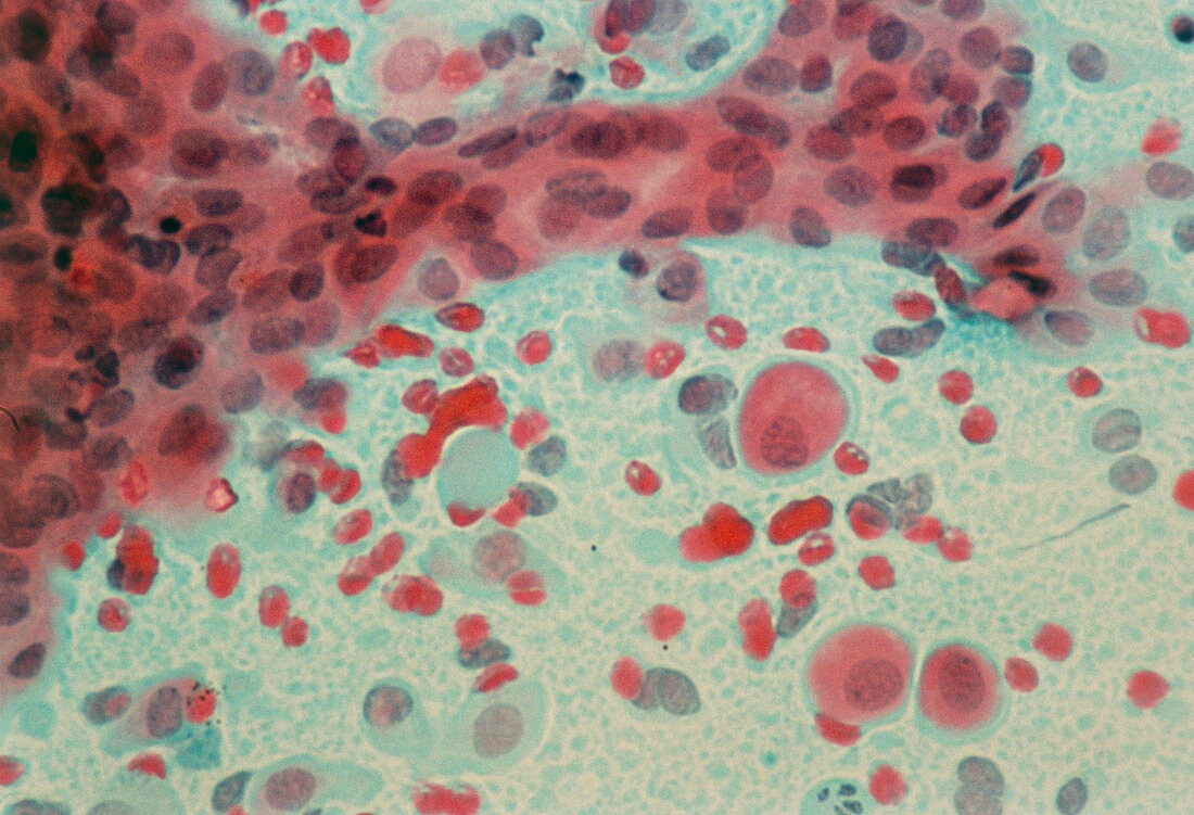 Light micrograph of atrophic squamous cervix cells