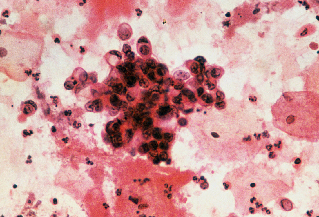 LM of cervical smear showing adenocarcinoma