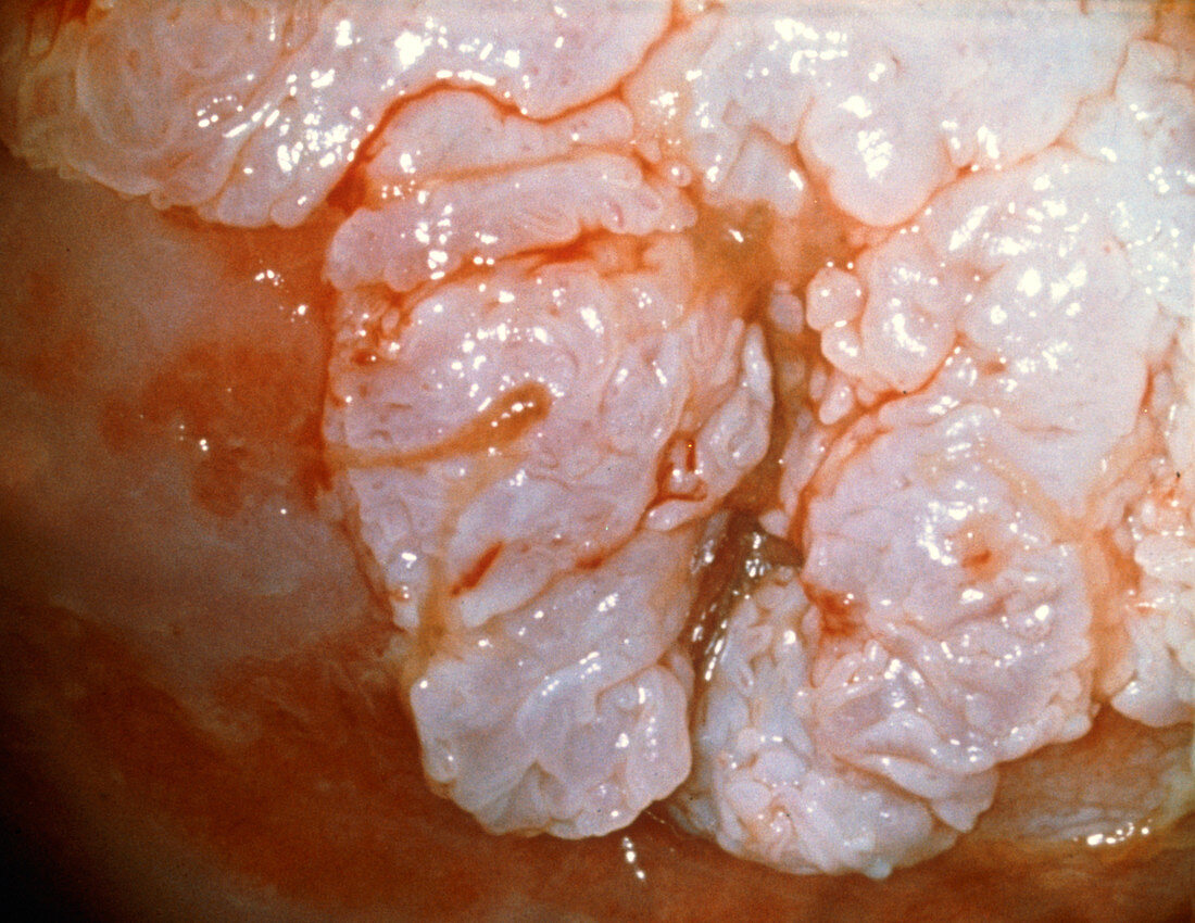 Colposcopy of genital wart lesion in cervix