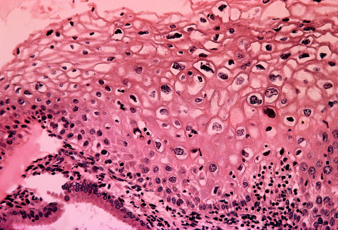 LM of cervix with human papilloma virus infection