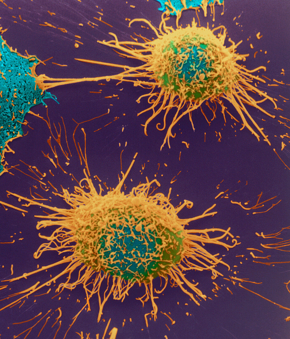 Coloured SEM of cervical cancer cells