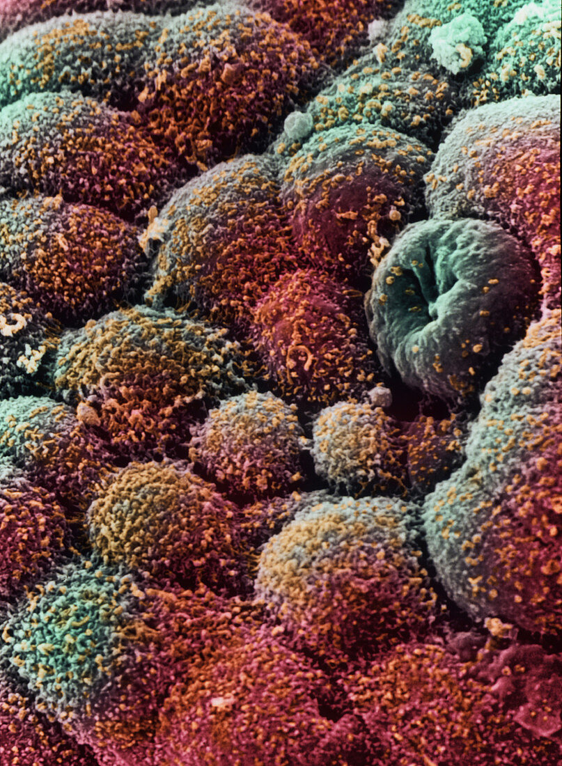 Coloured SEM of cancer cells of the ovary