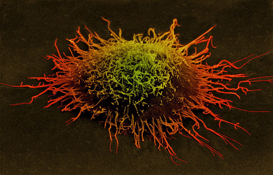 Coloured SEM of a cervical cancer cell