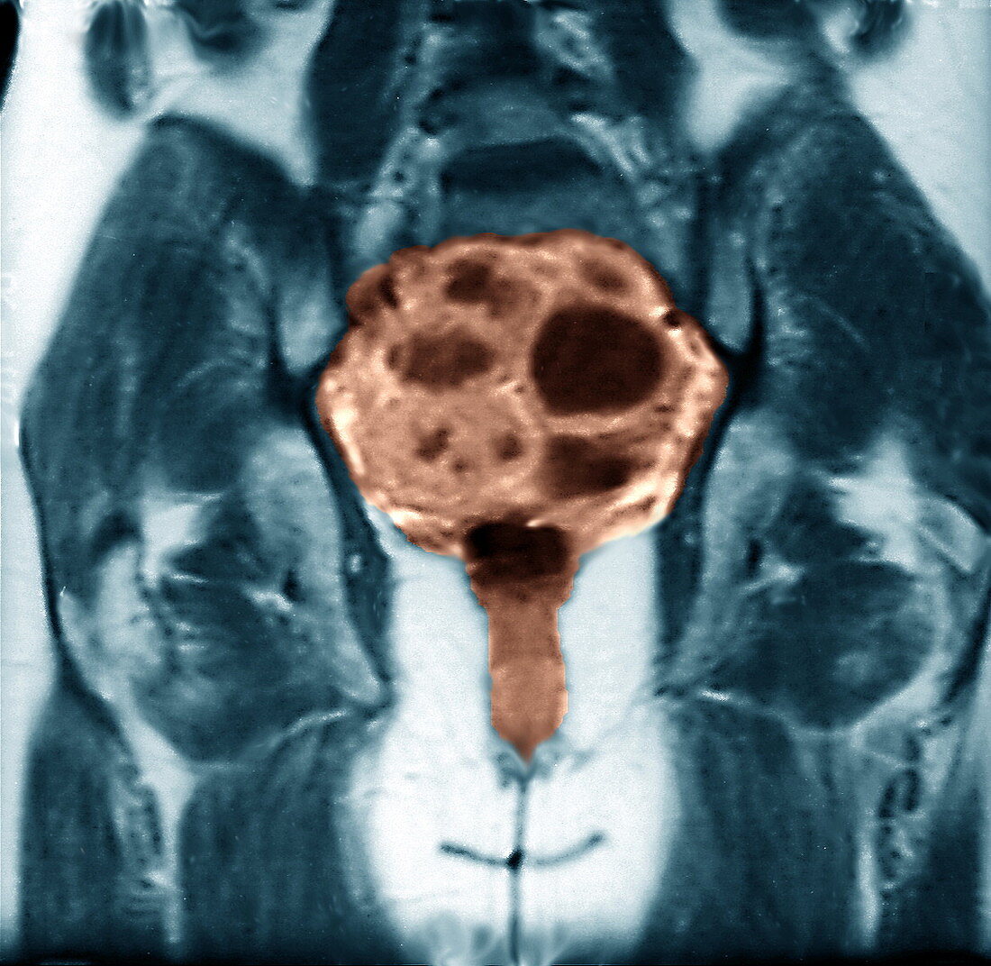 Ovarian cancer,MRI