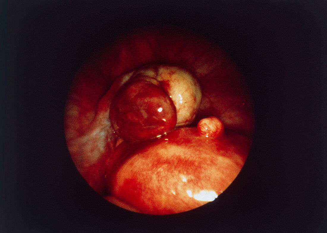 Uterine tumour