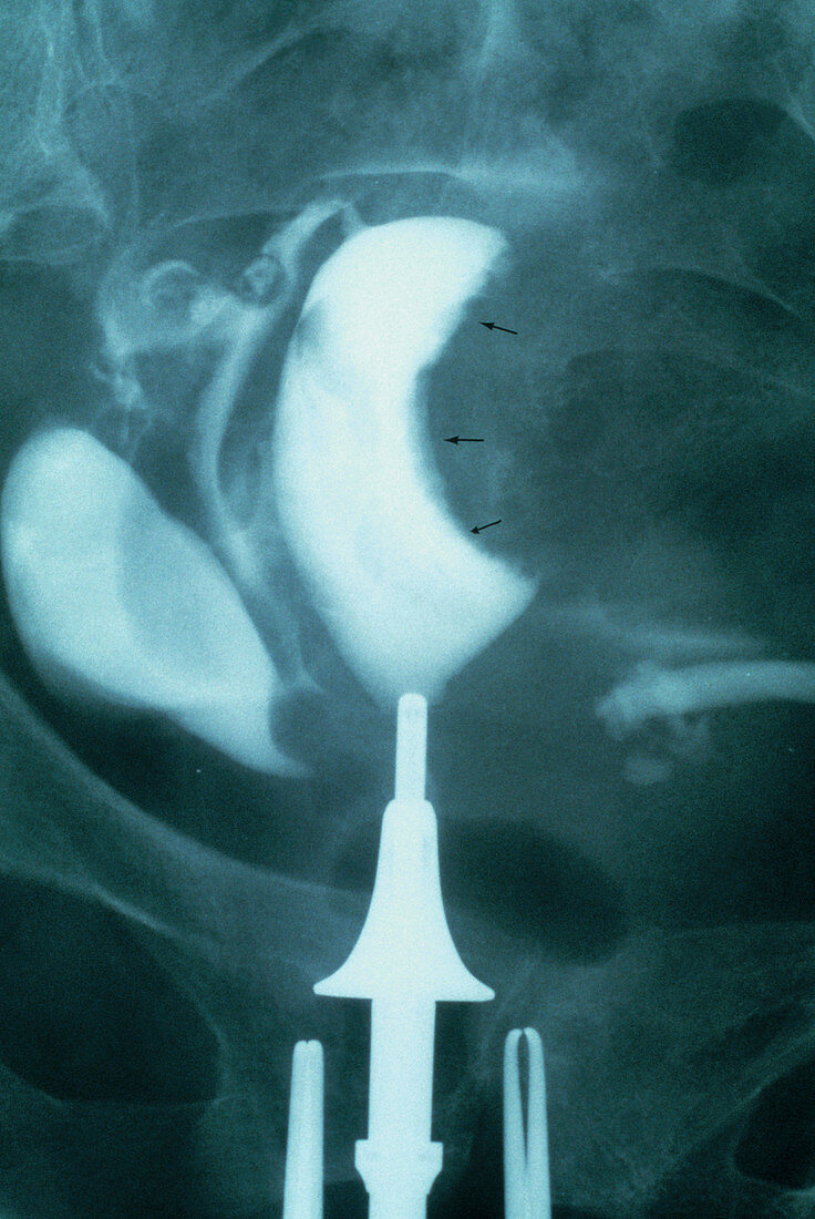 Uterine cancer,X-ray