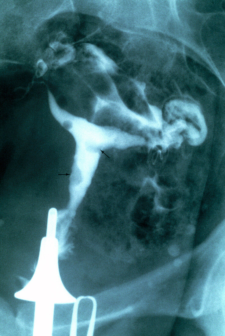 Uterine polyps,X-ray