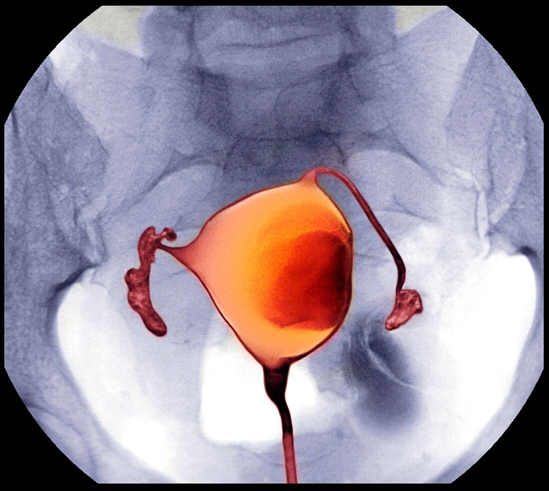 Uterine fibroid,X-ray