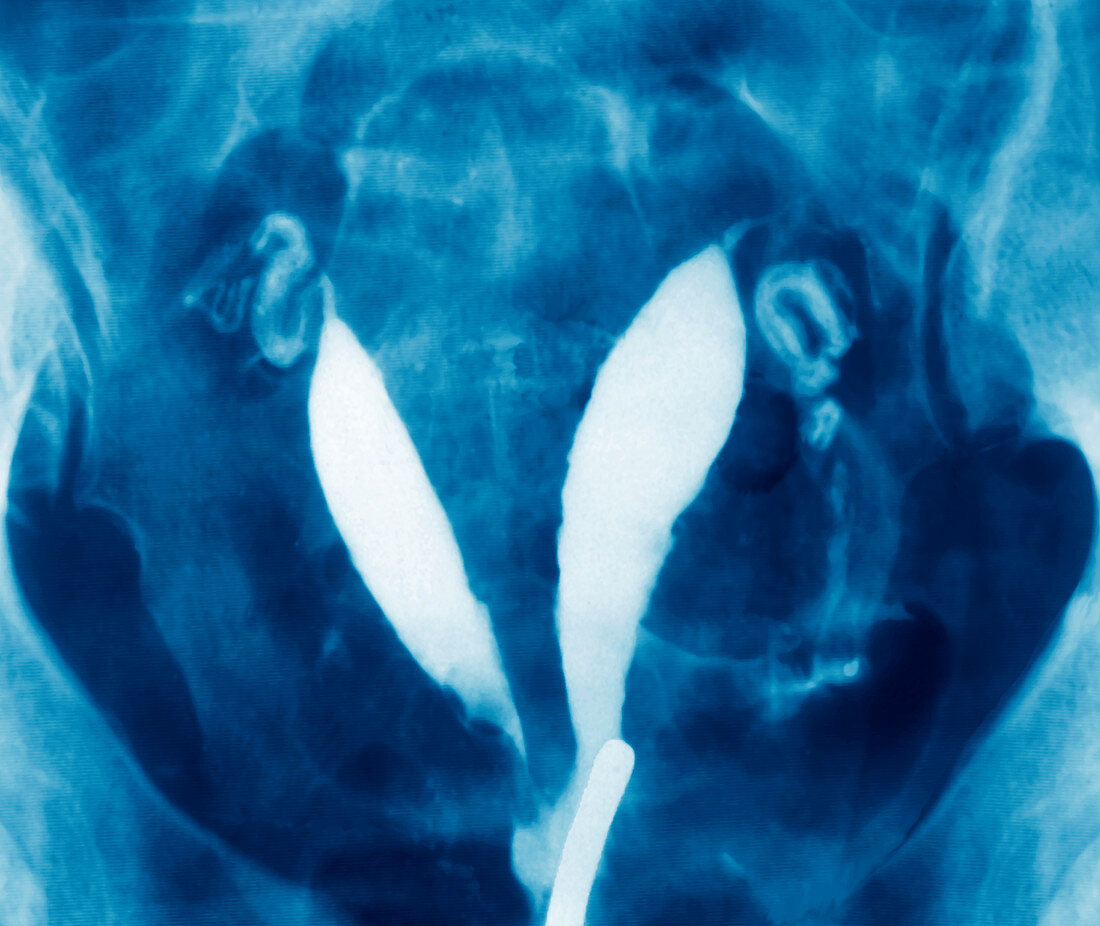 Deformed uterus,X-ray