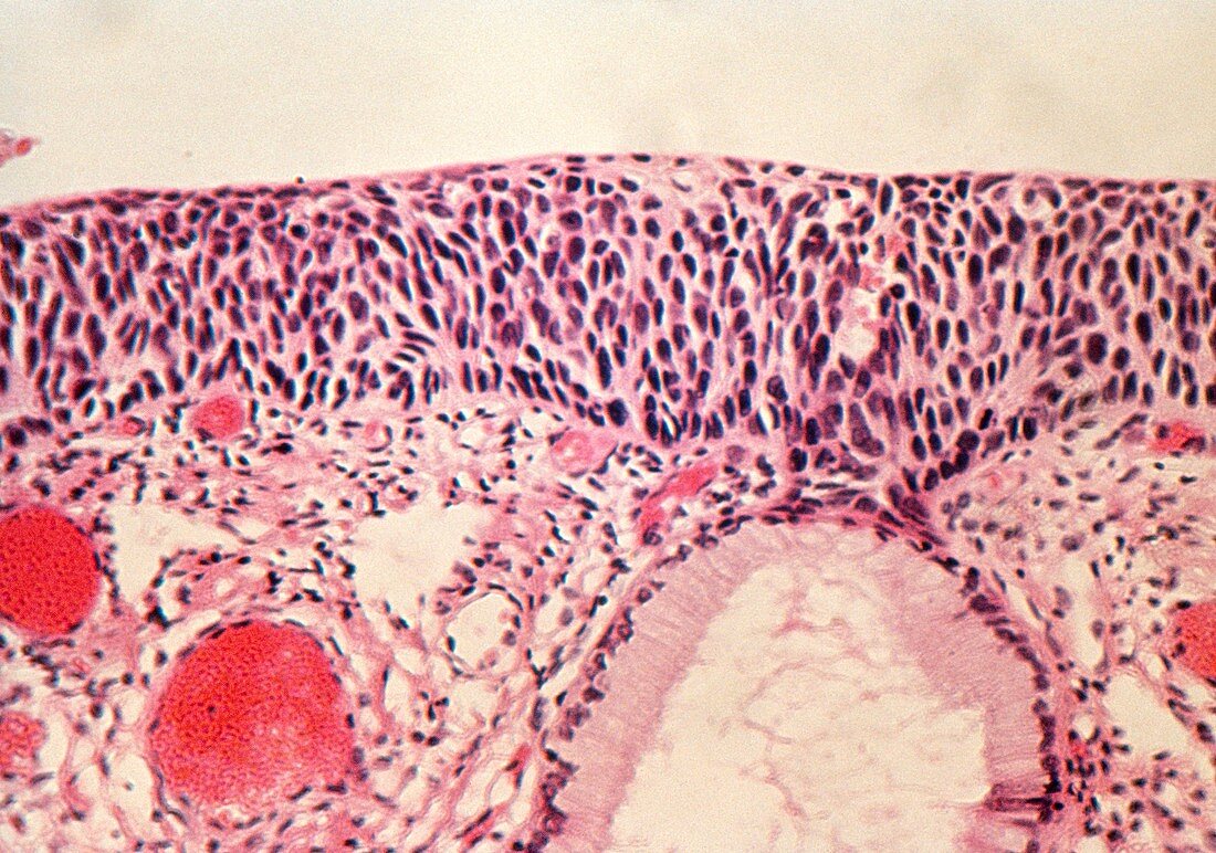 Light micrograph of cervix revealing carcinoma
