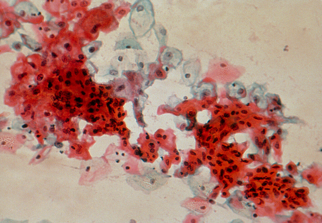 LM of cervical smear revealing HPV