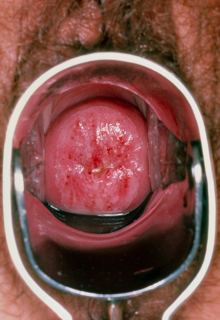 Colposcope image of the cervix showing CIN 2