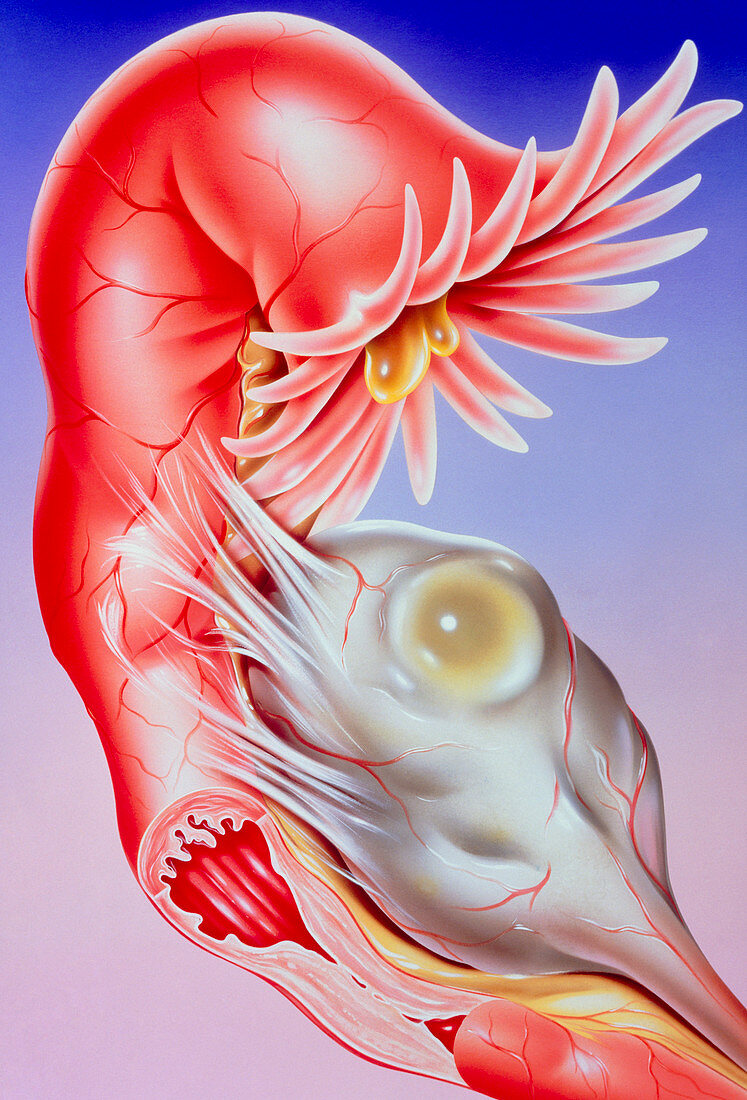 Illustration of fallopian tube infertility