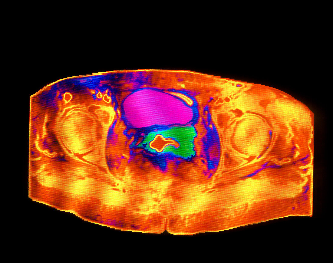 Coloured MRI of female pelvis in cervical cancer