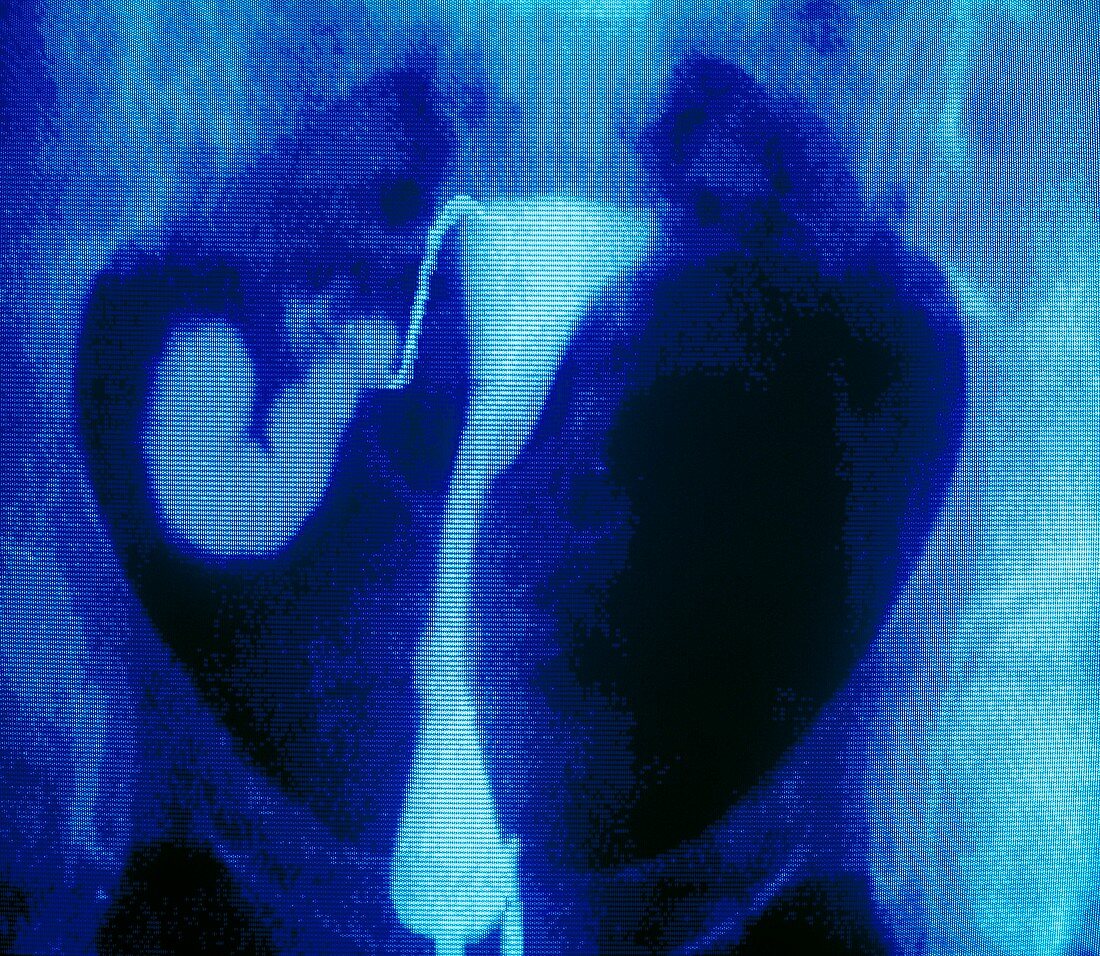 Infertility: f/col X-ray showing blocked tubes
