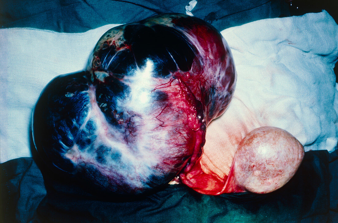 Surgical removal of bialateral ovarian cysts