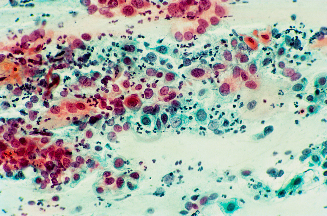 LM of severe dysplasia in a cervical smear