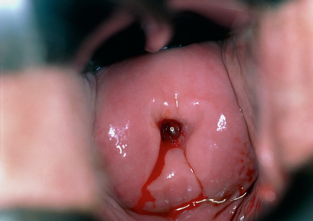 Colposcopy view of abnormal cervix (CIN3),stained
