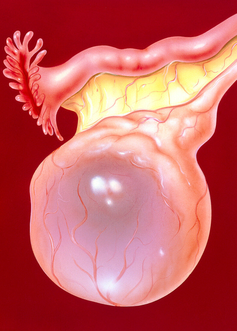 Illustration of an ovarian (follicular) cyst