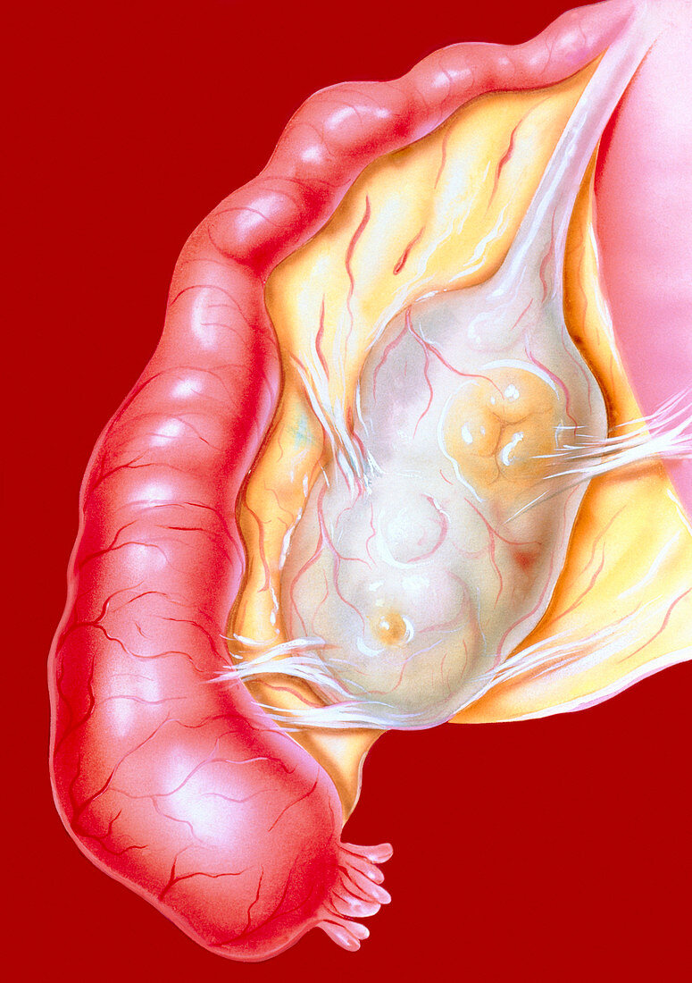Artwork of acute salpingitis of the fallopian tube