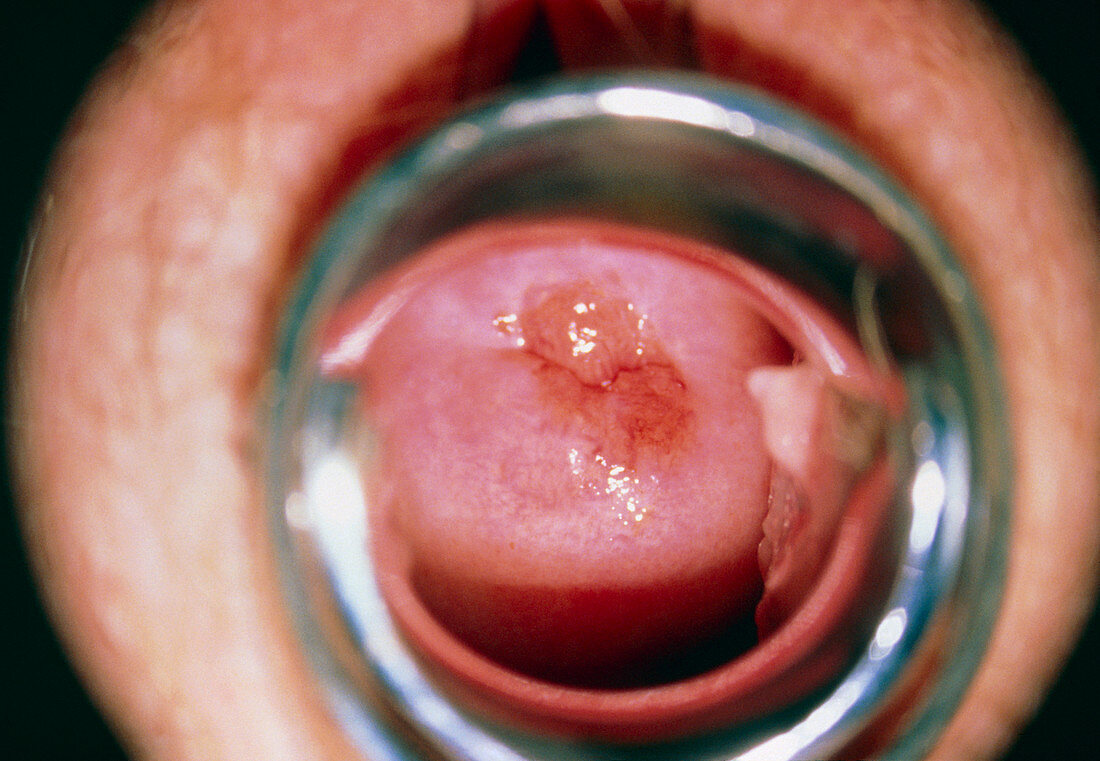 View of a cervix with mild (CIN 1) dysplasia