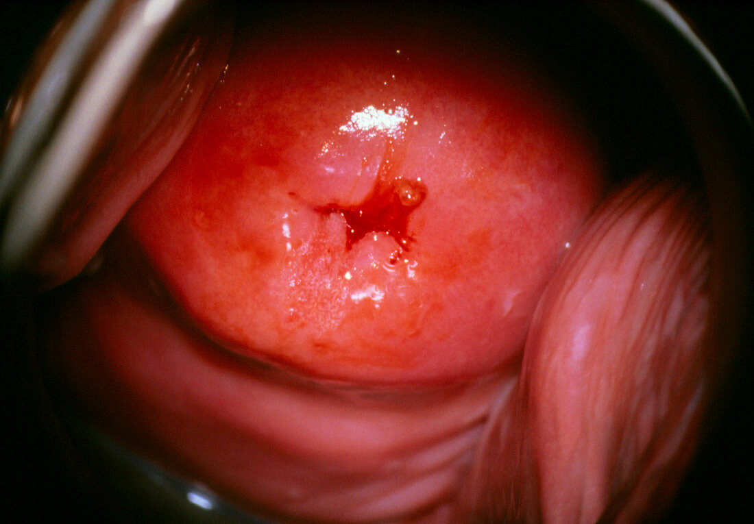 View of a cervix with moderate (CIN 1) dysplasia