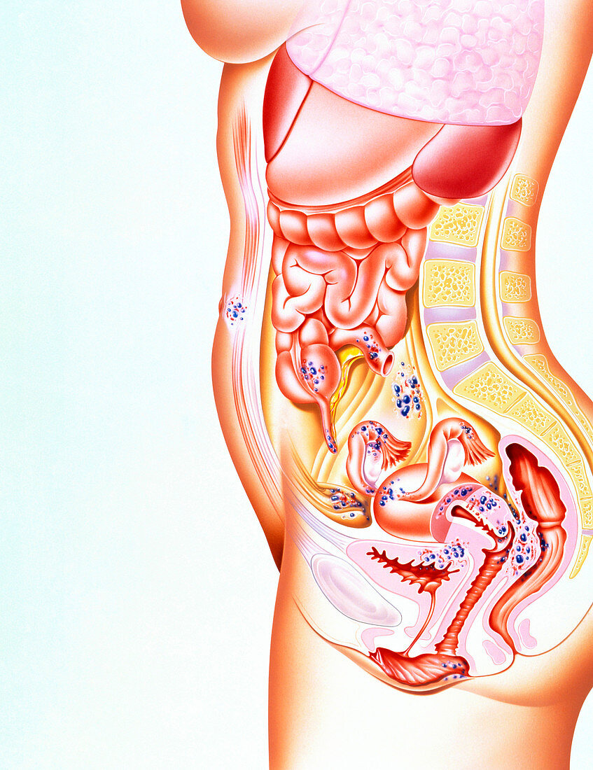 Artwork showing sites of endometriosis in body