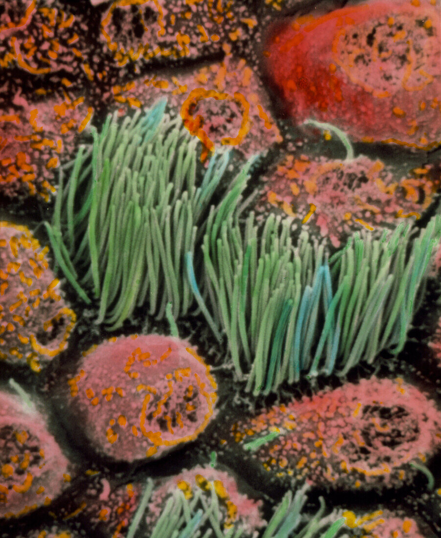 Coloured SEM of cancer cells of ovarian carcinoma
