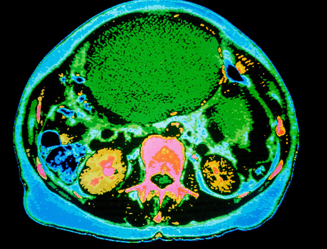 Coloured CT scan of ovarian cancer