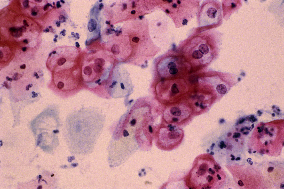 LM of cervical smear revealing HPV infection