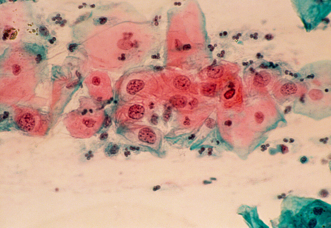 LM of cervical smear showing mild dysplasia