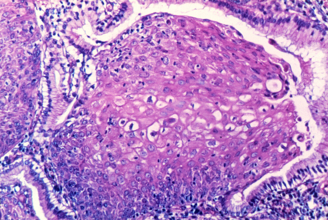 LM of section of through an inverted genital wart