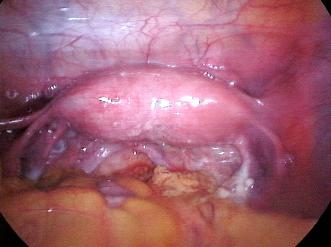 Uterus with septum