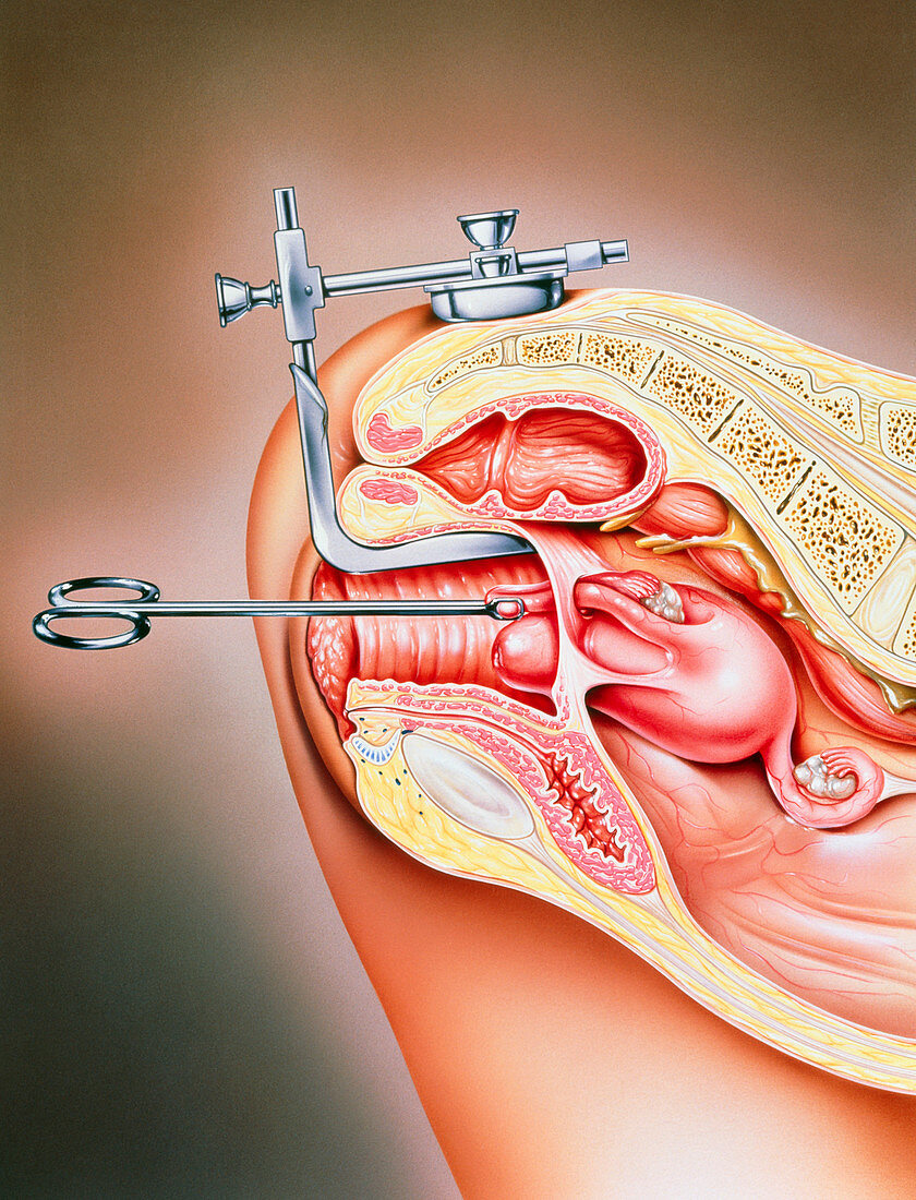 Illustration of female sterilization
