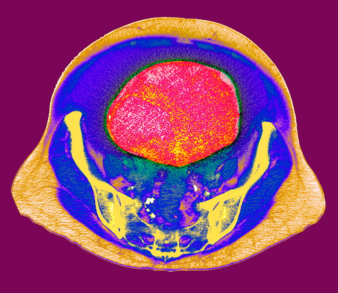 Ovarian cancer,CT scan