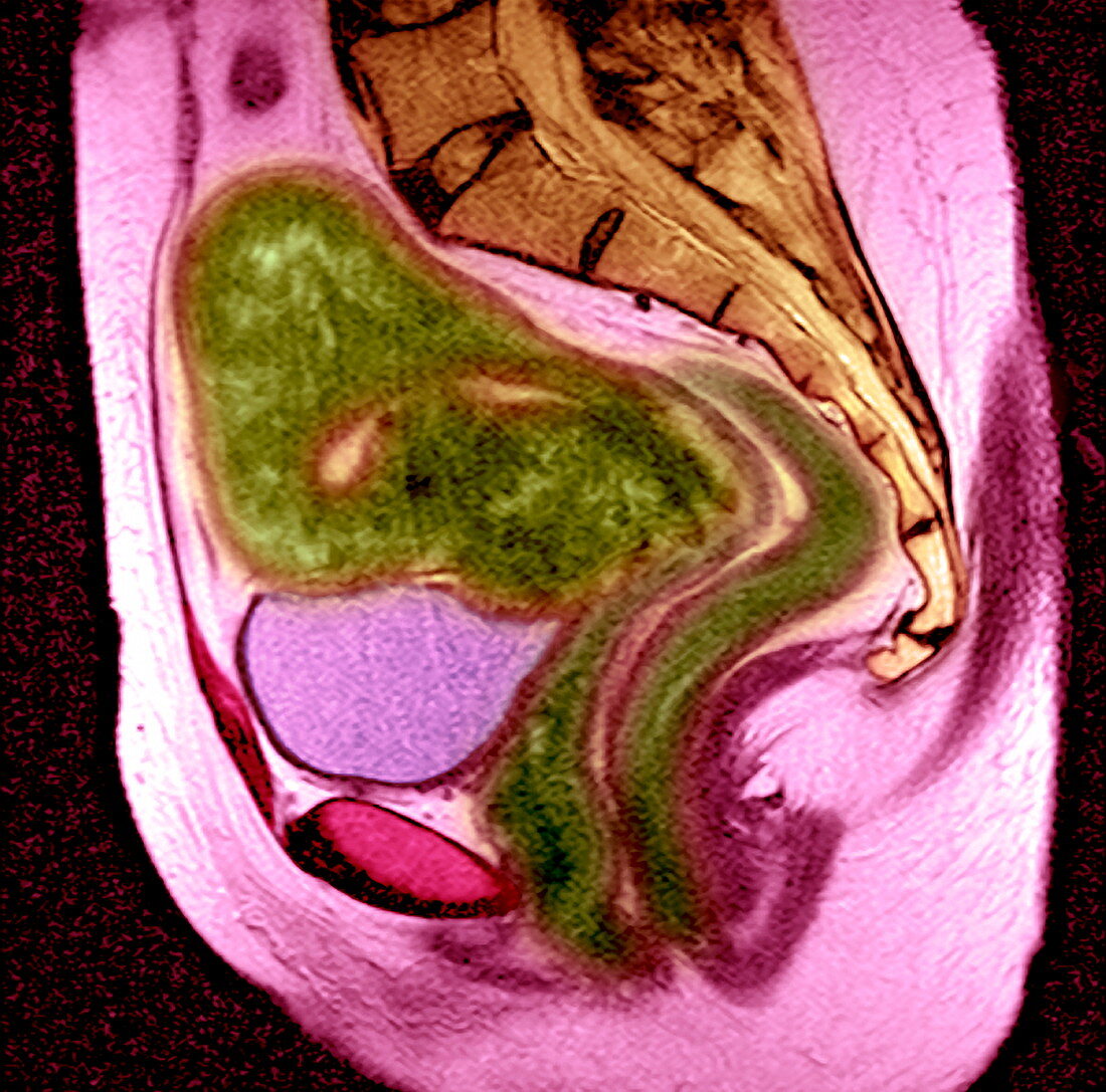 Uterine fibroid,MRI scan