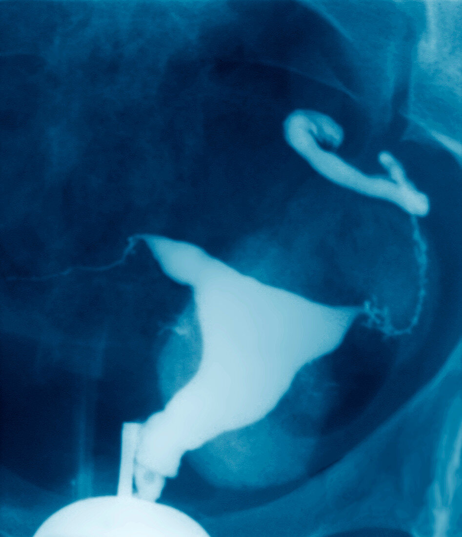 Swollen fallopian tubes,X-ray