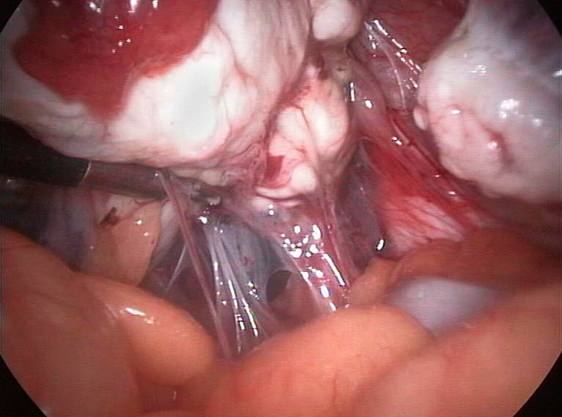 Ovarian adhesions